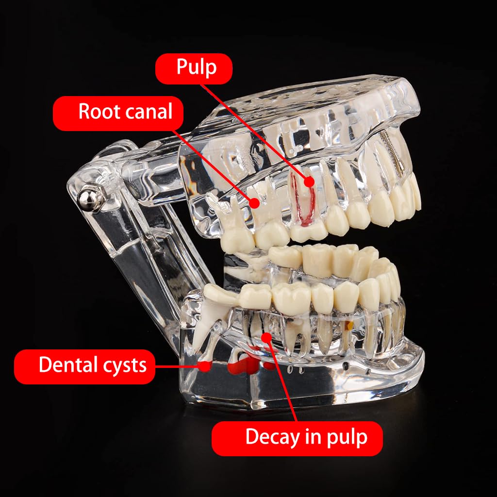Serplex Transparent Dental Model 1: 1 Adults Pathological Dental Model with Detachable Teeth Educational Tool for Dentists, Hygienists, Students Serplex Transparent Dental Model 1: 1 Adults Pathological Dental Model with Detachable Teeth Educational Tool for Dentists, Hygienists, Students